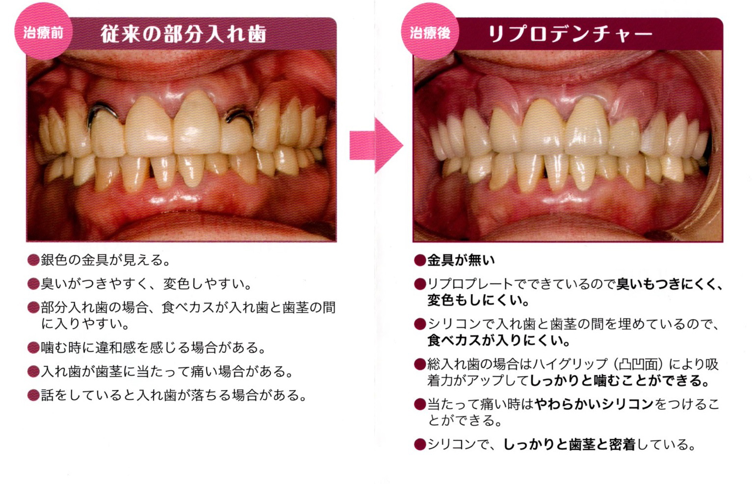 入れ歯 部分